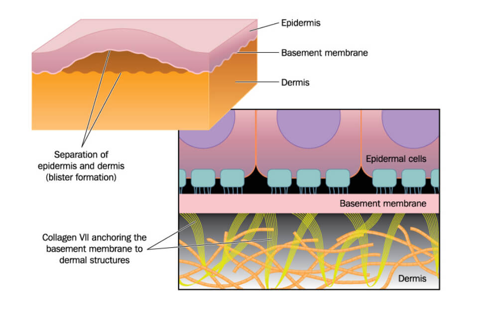 DIAGNOSIS AND TREATMENT OF EPIDERMOLYSIS BULLOSA
