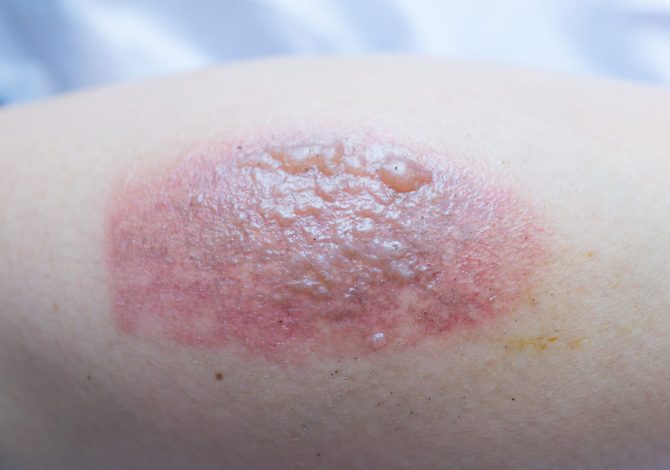 A QUICK OVERVIEW OF EPIDERMOLYSIS BULLOSA