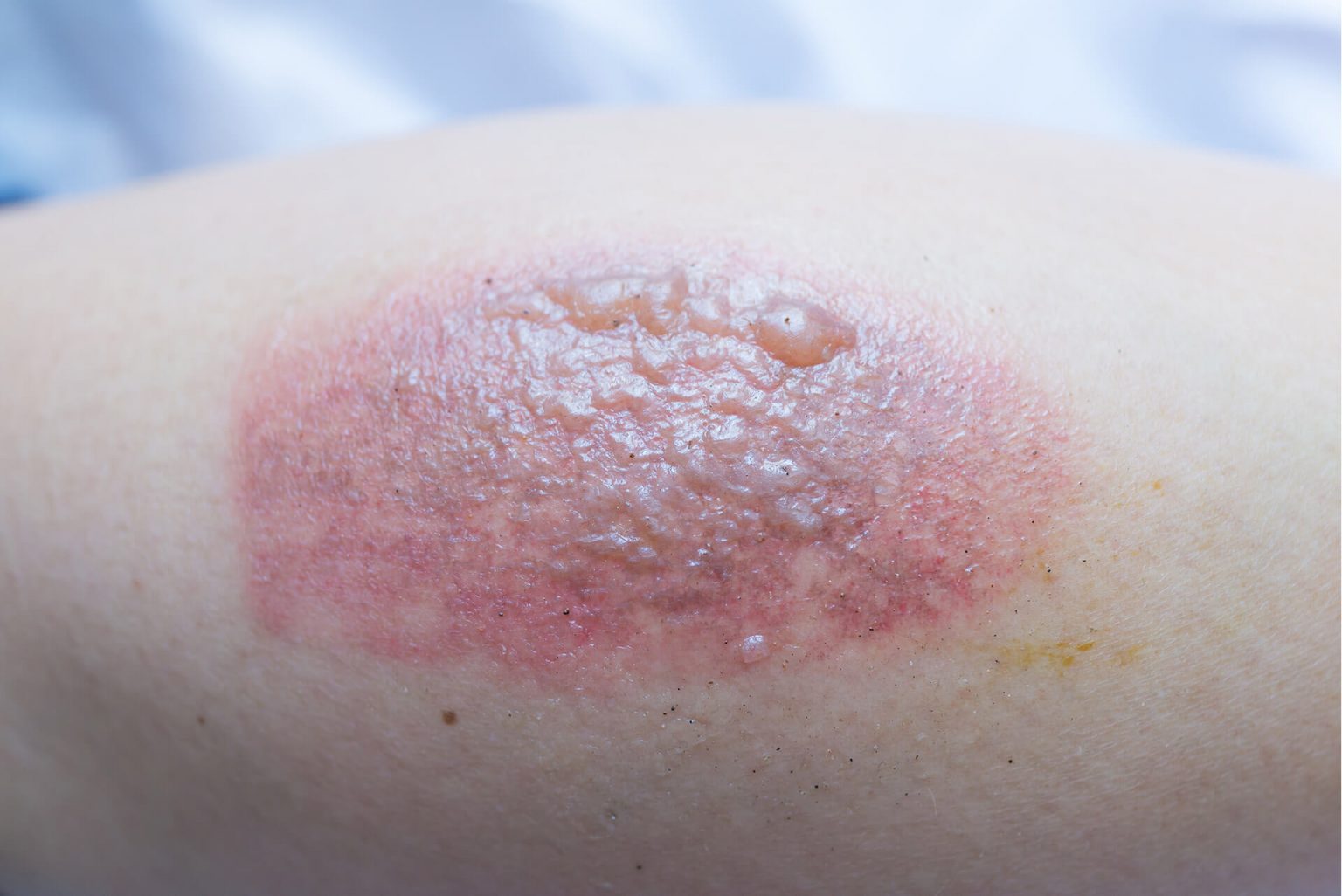 A Quick Overview of Epidermolysis Bullosa and It's Symptoms