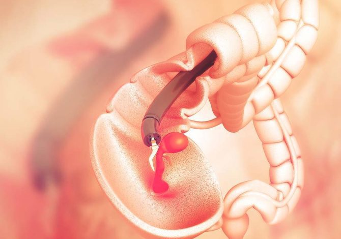 COMMON SIGNS AND SYMPTOMS OF COLORECTAL CANCER