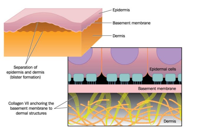 DIAGNOSIS AND TREATMENT OF EPIDERMOLYSIS BULLOSA