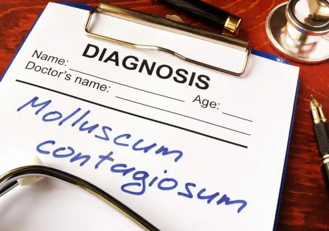 WHAT IS MOLLUSCUM CONTAGIOSUM AND HOW IT IS DIAGNOSED