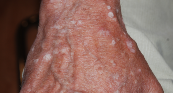 skin condition, noncancerous growths