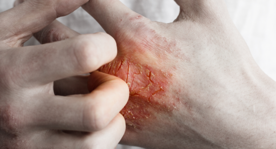 Itchy, scaling hand, common ichthyosis symptom