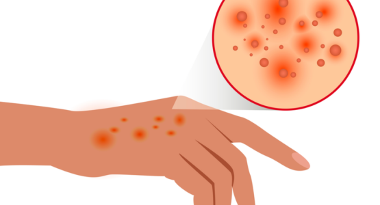 What is Atopic Dermatitis?