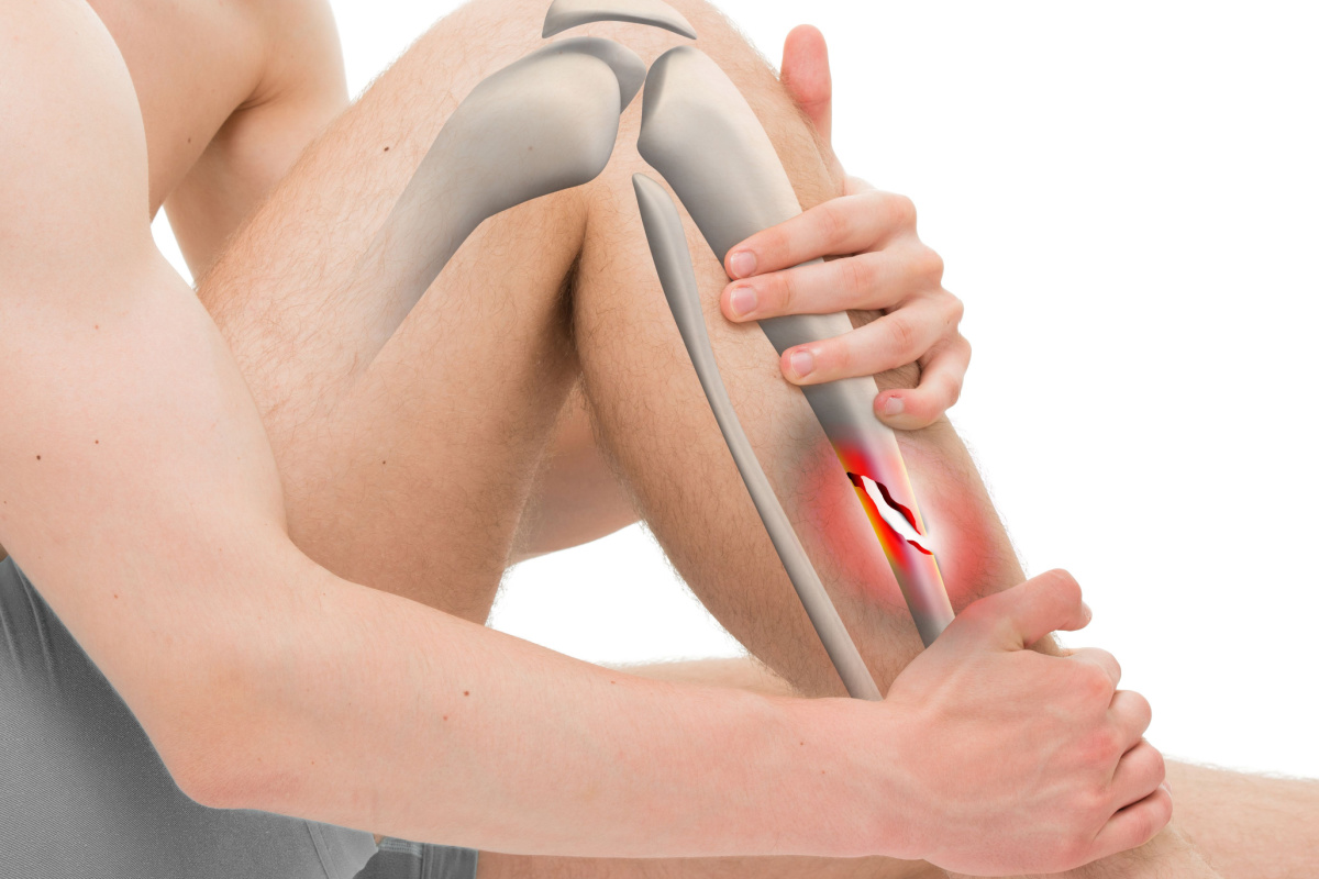 illustration of fracture