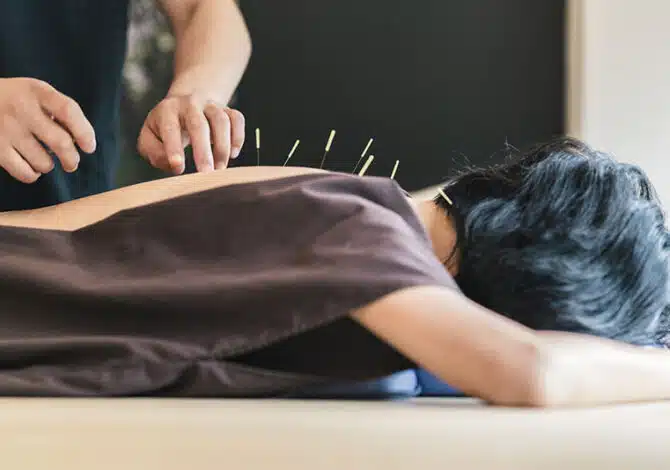 Therapist,Giving,Acupuncture,Treatment,To,A,Japanese,Woman