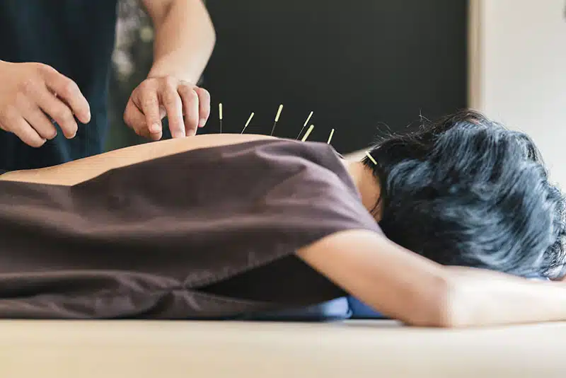 Therapist,Giving,Acupuncture,Treatment,To,A,Japanese,Woman